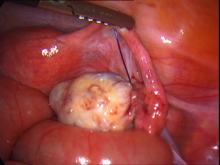 suture loop tight around ovarian pedicle